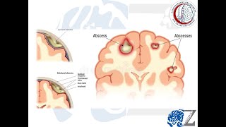 CNS Infection 1  Brain Abscess 1 خُراج بالمخ [upl. by Ujawernalo]