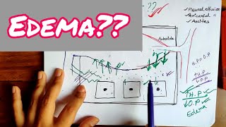 Edema  Physiology of Edema  Mechanism of Edema  Bangla Demonstration of Edema  Edema Physiology [upl. by Niarda]