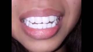 Smile MakeoverPerfect white Teeth [upl. by Lapham]