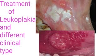 Treatment of LeukoplakiaTypes of Leukoplakia Different treatment modalities of Leukoplakia PVLVH [upl. by Qiratla179]