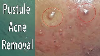 How to Remove Girls Pustular Rosacea Acne on the Cheek [upl. by Nawtna]