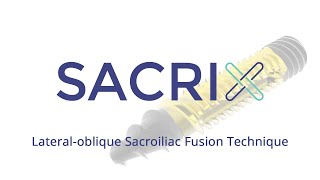 Sacrix  Revolutionary Advance in Sacroiliac Joint Treatment [upl. by Otrevlig]