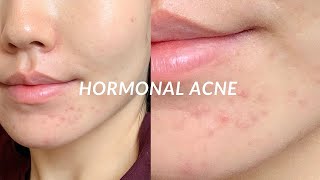 HORMONAL ACNE миний зуны турш тэмцсэн гормоны батганы түүх болон хэрхэн эдгээсэн тухай 🤩 [upl. by Melia712]