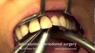 Laserassisted periodontal surgery [upl. by Woodie]