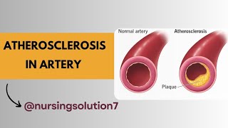 Atherosclerosis in hindi  Atheroma plaque formation in the artery [upl. by Warthman]