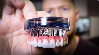 DENTURES vs Dental IMPLANTS Full Mouth Rehabilitation  See the Smile Transformation [upl. by Lorrie]