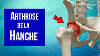 Arthrose de la hanche  Explication et Traitement [upl. by Ocsinarf]