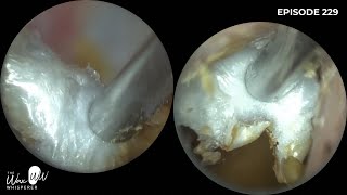 229  This patient attended with a suspected benign osteonecrosis and otomycosis [upl. by Royal438]