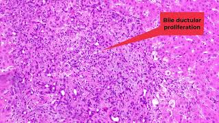 Histological features of chronic cholestasis [upl. by Morly]