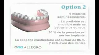 Implants dentaires  Prothèse amovible sur barre [upl. by Euqnimod]