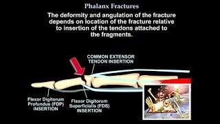 Phalanx Fractures  Everything You Need To Know  Dr Nabil Ebraheim [upl. by Aisilef]