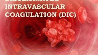 Disseminated Intravascular Coagulation [upl. by Eneiluj41]