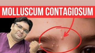 MOLLUSCUM CONTAGIOSUM REMOVAL 😱 [upl. by Reade]