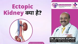 What is Ectopic Kidney  Causes and Treatment in Hindi  Dr Jitendra Kumar  Nephrologist Haryana [upl. by Isabella]