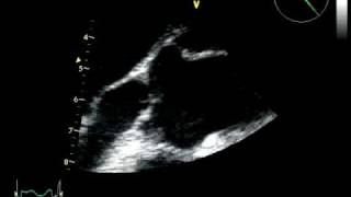 BIG AORTIC VEGETATION  INFECTIVE ENDOCARDITIS ECHOCARDIOGRAPHY cardiac ultrasound [upl. by Xirdnek]