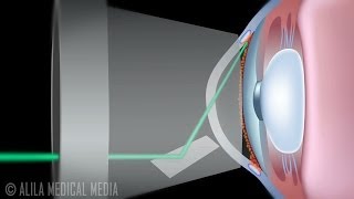 Laser Trabeculoplasty for Glaucoma ALT vs SLT Animation [upl. by Annazus]