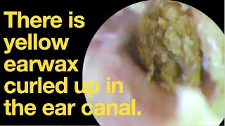 There is yellow earwax curled up in the ear canalear wax removal  ear cleaning  ASMR  relax [upl. by Lauraine844]