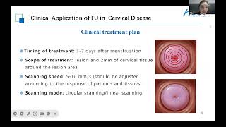 Focused Ultrasound for Cervical Intraepithelial NeoplasiaCIN [upl. by Kwarteng141]