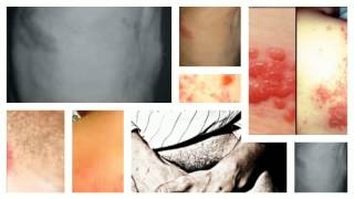 Other Symptoms Of Shingles Rash [upl. by Noraa]