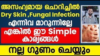 ചൊറിച്ചിൽDry skinFungal Infection എന്നിവ മാറുന്നില്ലെങ്കിൽ ഇങ്ങനെ ചെയ്ത് നോക്കുdry skinchorichil [upl. by Adelaide210]