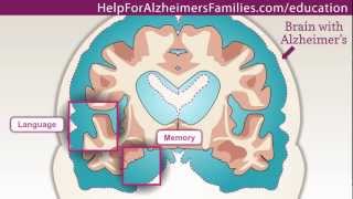 Alzheimers Effect on the Brain [upl. by Daune]