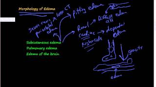 45Morphology of Edema Subcutaneous edema Pulmonary edema Edema of the brain [upl. by Severen]