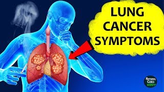 Lung Cancer Early Sign and Symptoms  Natural Cures Secret [upl. by Fermin]