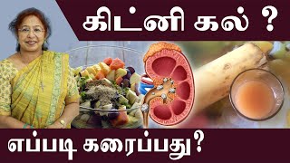 kidney stone  How to Cure it   daisy daisyhospital cure kidneystone [upl. by Wake]