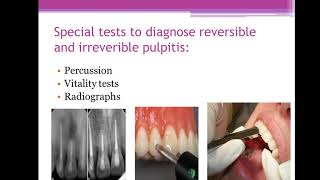 45The difference between reversible pulpitis and irreversible pulpitisMFDSMJDFORE [upl. by Novah]