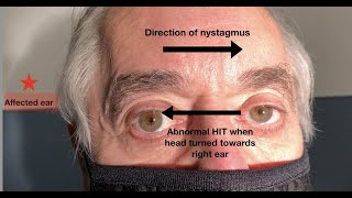 What ear does the nystagmus in vestibular neuritis beat towards [upl. by Larcher]