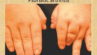 Approach to Polyarthritis Patient By Dr Haidy Ali [upl. by Jochebed31]