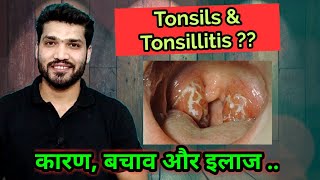 What is tonsillitis  Prevention amp treatment [upl. by Aileek]