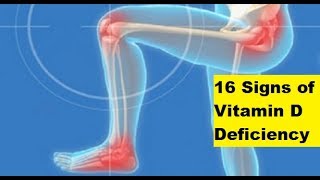 16 Signs of Vitamin D Deficiency  Signs of Vitamin D Deficiency [upl. by Adnalor]