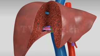 Liver transplant Living donor right hepatectomy donor procedure [upl. by Ingaborg]