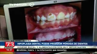 Hipoplasia dental puede producir pérdida de dientes [upl. by Ciapas]