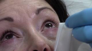 Blephex Blepharitis Treatment at Face amp Eye [upl. by Lexis]