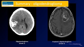 Emergency Imaging of Brain Tumors Oligodendrogliomas amp Others [upl. by Annadiane800]