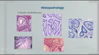 Omneya Wahba Odontogenic Tumors 1 [upl. by Asilet]