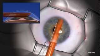 EndoSaver® Corneal Endothelium Delivery Instrument Instructional VideoJune 2012longmp4 [upl. by Calbert43]