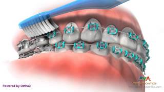 Life with Braces  Brushing amp Flossing [upl. by Lekram87]