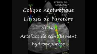 Vscan Calculs uretère distal Artefact scintillement Hydronephrose [upl. by Winchester]