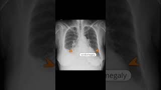 Congestive heart failure xray shoets [upl. by Naus]