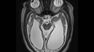 Periventricular Leukomalacia [upl. by Ronaele956]