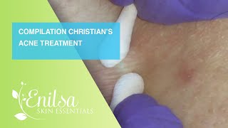 Compilation of Christian’s Acne Treatment [upl. by Anoiek]