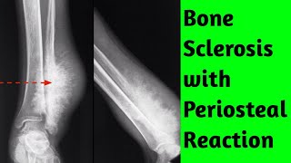 Bone sclerosis with periosteal reaction Differential Diagnosis [upl. by Ayat]