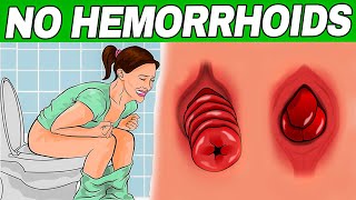 Get Rid of Hemorrhoids Fast Know the Symptoms and Best Treatment for Lasting Relief [upl. by Fridell]