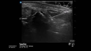 Wrist Ultrasound Distal Radius Fracture Hematoma Block [upl. by Ahsatak]