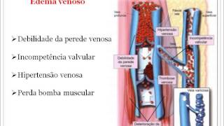 Semiologia do Edema [upl. by Spiros]