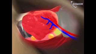 Minimally Invasive Total Thyroidectomy Video [upl. by Mitchell]