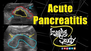 Acute Pancreatitis  Ultrasound  CT  Case 206 [upl. by Odlavso977]